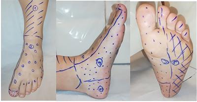 Stimulation TcPO2 Testing Improves Diagnosis of Peripheral Arterial Disease in Patients With Diabetic Foot